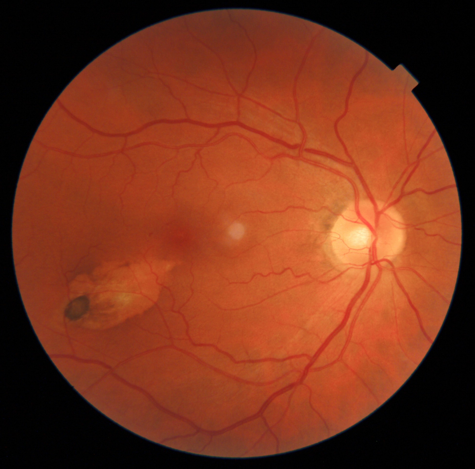 Retinal tracker eye